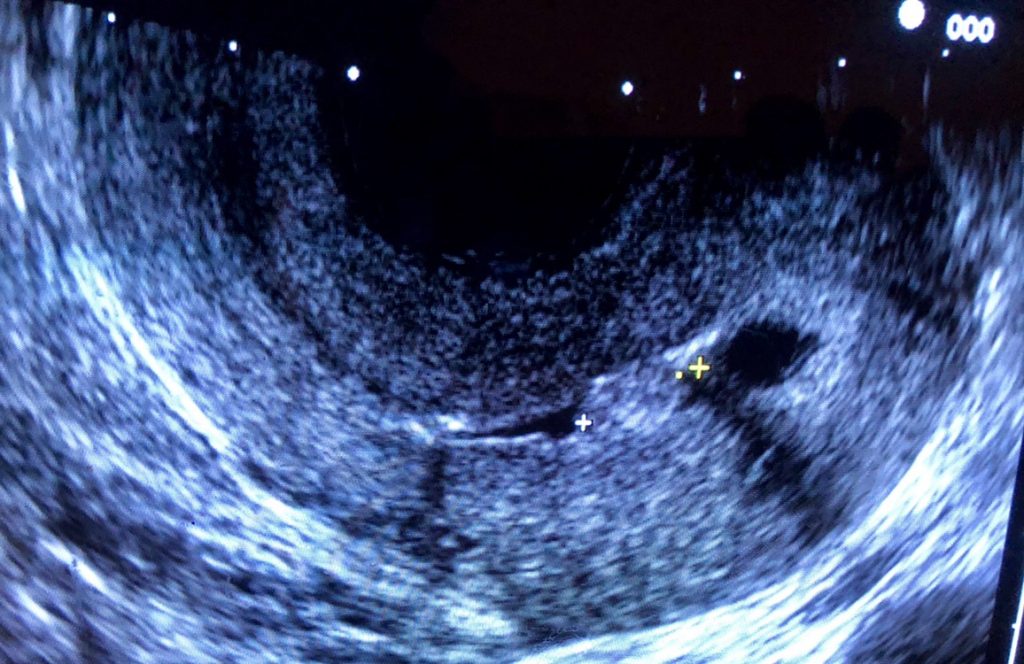 Article : Connaissez vous l’hystérosonographie et l’HyFoSy ?